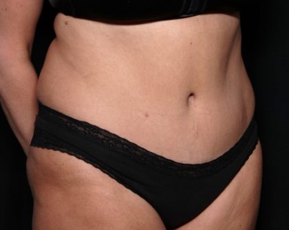 Tummy Tuck Before & After Patient #31363