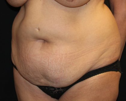 Tummy Tuck Before & After Patient #31363