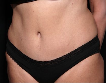 Tummy Tuck Before & After Patient #31363