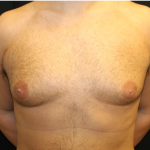 Gynecomastia Before & After Patient #31387