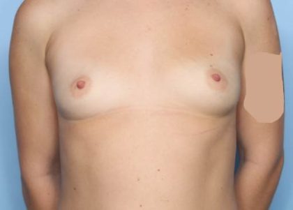 Breast Augmentation Before & After Patient #31453