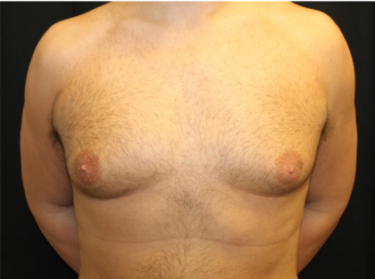 Gynecomastia Before & After Patient #31387