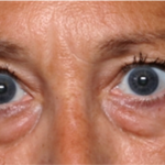 Blepharoplasty Before & After Patient #31420
