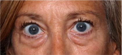 Blepharoplasty Before & After Patient #31420