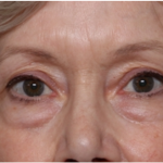 Blepharoplasty Before & After Patient #31443