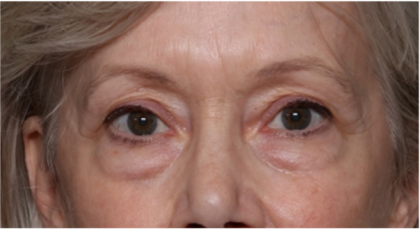 Blepharoplasty Before & After Patient #31443