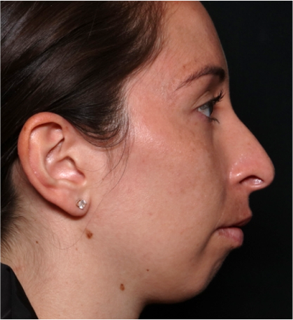 Chin Augmentation Before & After Patient #31453