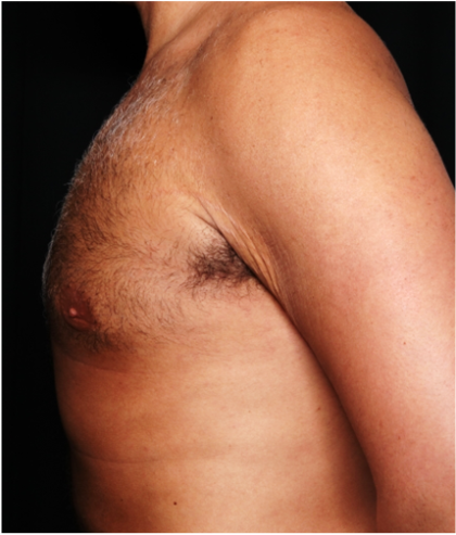 Gynecomastia Before & After Patient #31387