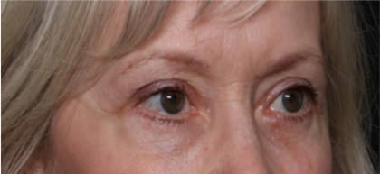 Blepharoplasty Before & After Patient #31443