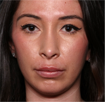 Chin Augmentation Before & After Patient #31453