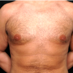 Gynecomastia Before & After Patient #31387