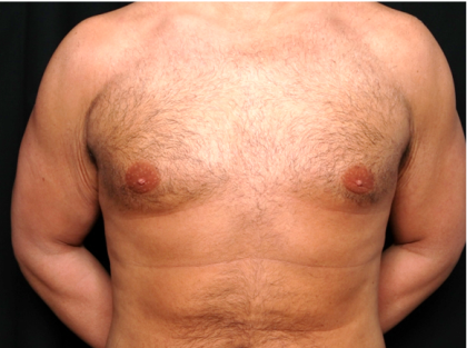 Gynecomastia Before & After Patient #31387