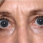 Blepharoplasty Before & After Patient #31420