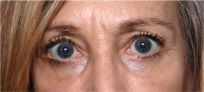 Blepharoplasty Before & After Patient #31420