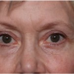 Blepharoplasty Before & After Patient #31443