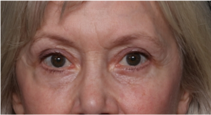 Blepharoplasty Before & After Patient #31443