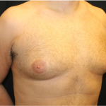 Gynecomastia Before & After Patient #31387