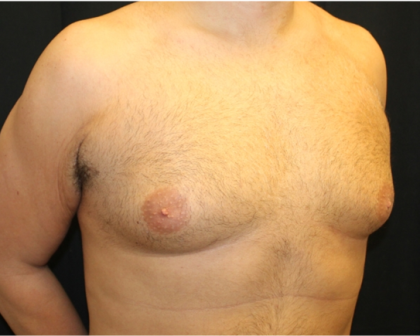 Gynecomastia Before & After Patient #31387