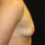 Breast Lift Before & After Patient #31376