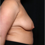 Breast Lift with Implant Before & After Patient #31409