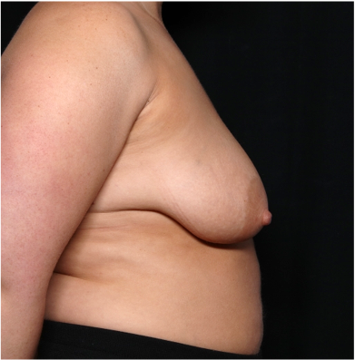 Breast Lift with Implant Before & After Patient #31409