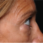 Blepharoplasty Before & After Patient #31420