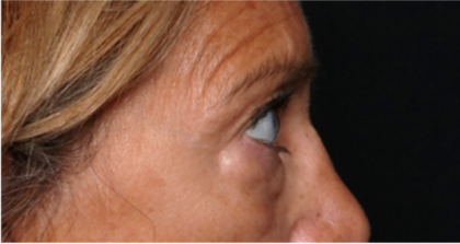 Blepharoplasty Before & After Patient #31420