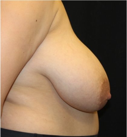 Breast Reduction Before & After Patient #31474