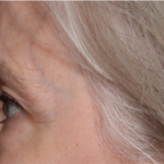 Blepharoplasty Before & After Patient #31443