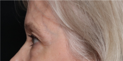 Blepharoplasty Before & After Patient #31443