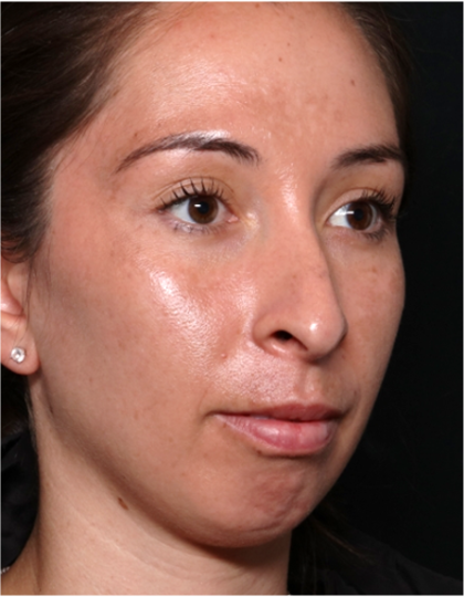 Chin Augmentation Before & After Patient #31453