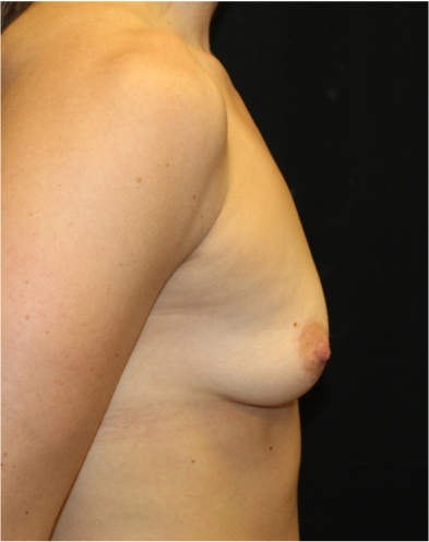 Breast Lift Before & After Patient #31376