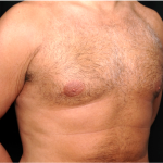 Gynecomastia Before & After Patient #31387