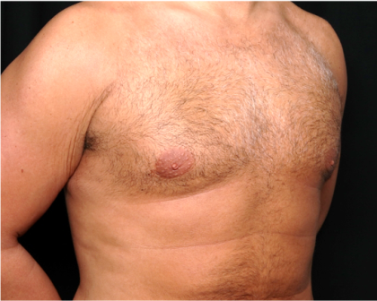 Gynecomastia Before & After Patient #31387