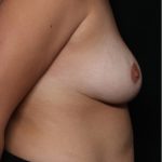 Breast Reduction Before & After Patient #31474