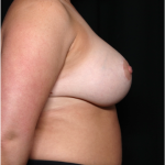 Breast Lift with Implant Before & After Patient #31409