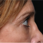 Blepharoplasty Before & After Patient #31420