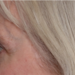 Blepharoplasty Before & After Patient #31443