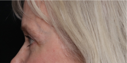 Blepharoplasty Before & After Patient #31443