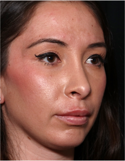 Chin Augmentation Before & After Patient #31453