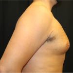 Gynecomastia Before & After Patient #31387