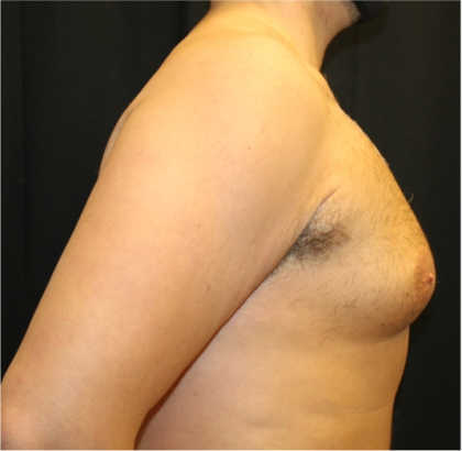 Gynecomastia Before & After Patient #31387