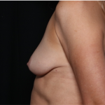 Breast Augmentation - Round Silicone Implants Before & After Patient #31398