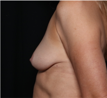 Breast Augmentation - Round Silicone Implants Before & After Patient #31398