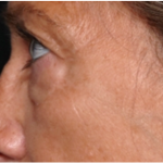 Blepharoplasty Before & After Patient #31420