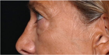 Blepharoplasty Before & After Patient #31420