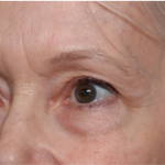 Blepharoplasty Before & After Patient #31443