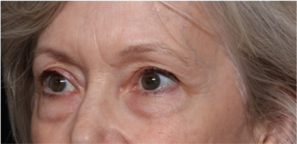 Blepharoplasty Before & After Patient #31443