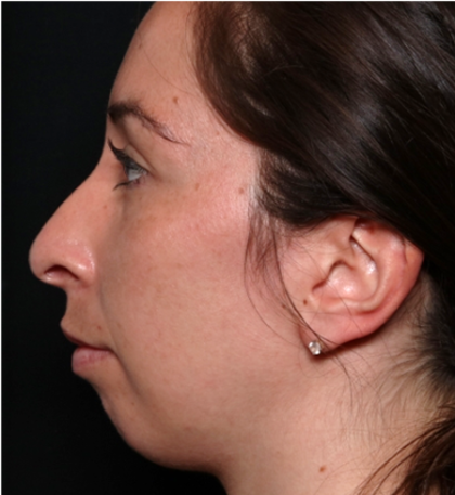 Chin Augmentation Before & After Patient #31453