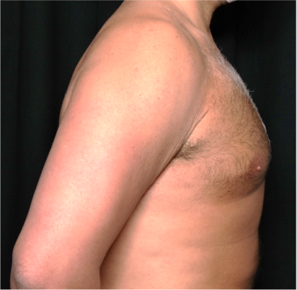 Gynecomastia Before & After Patient #31387